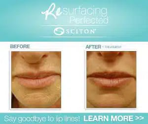 Sciton laser resurfacing before and after photo