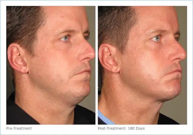 Ultherapy: An Uplift, not a Facelift! 2 Ultherapy treatment before and after photo