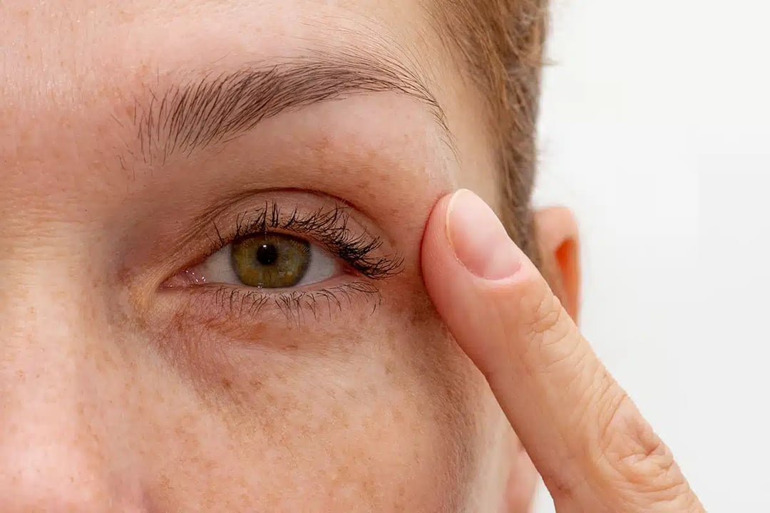 Improve the Look of Your Eyes with Eyelid Surgery
