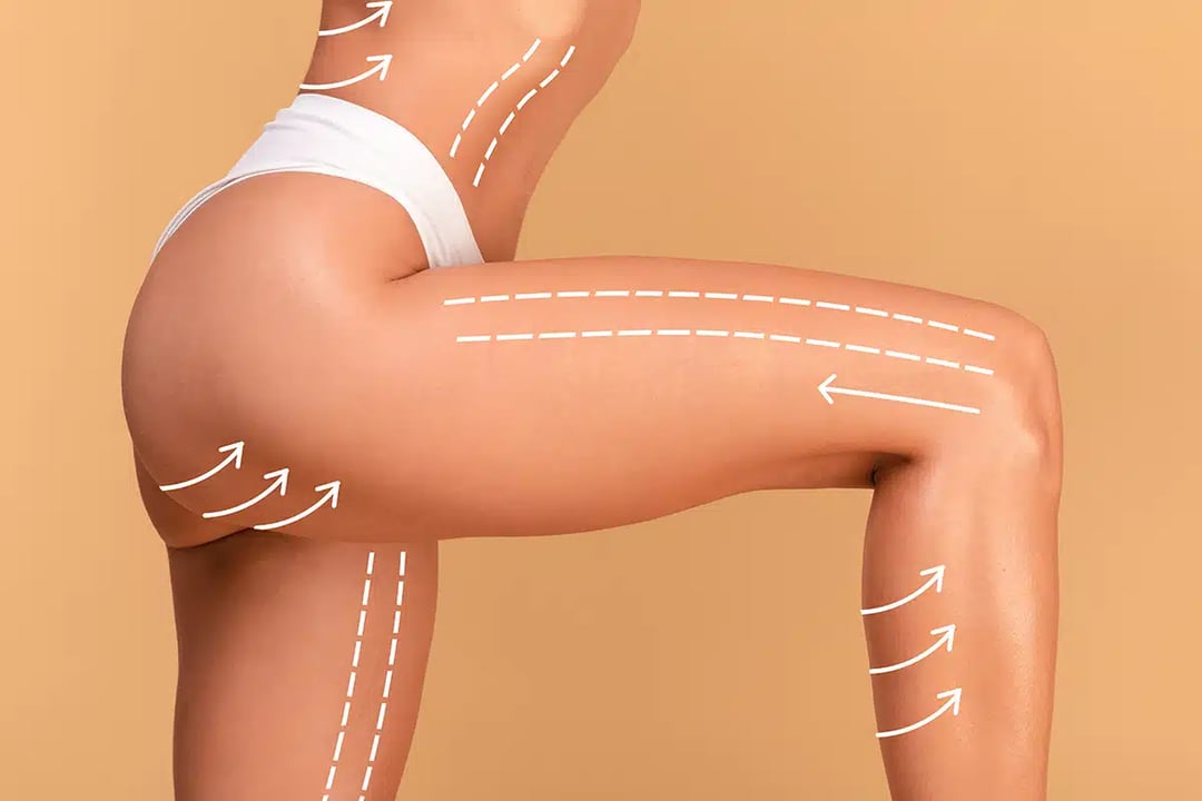 Which Areas of the Body Can Be Treated with Liposuction?