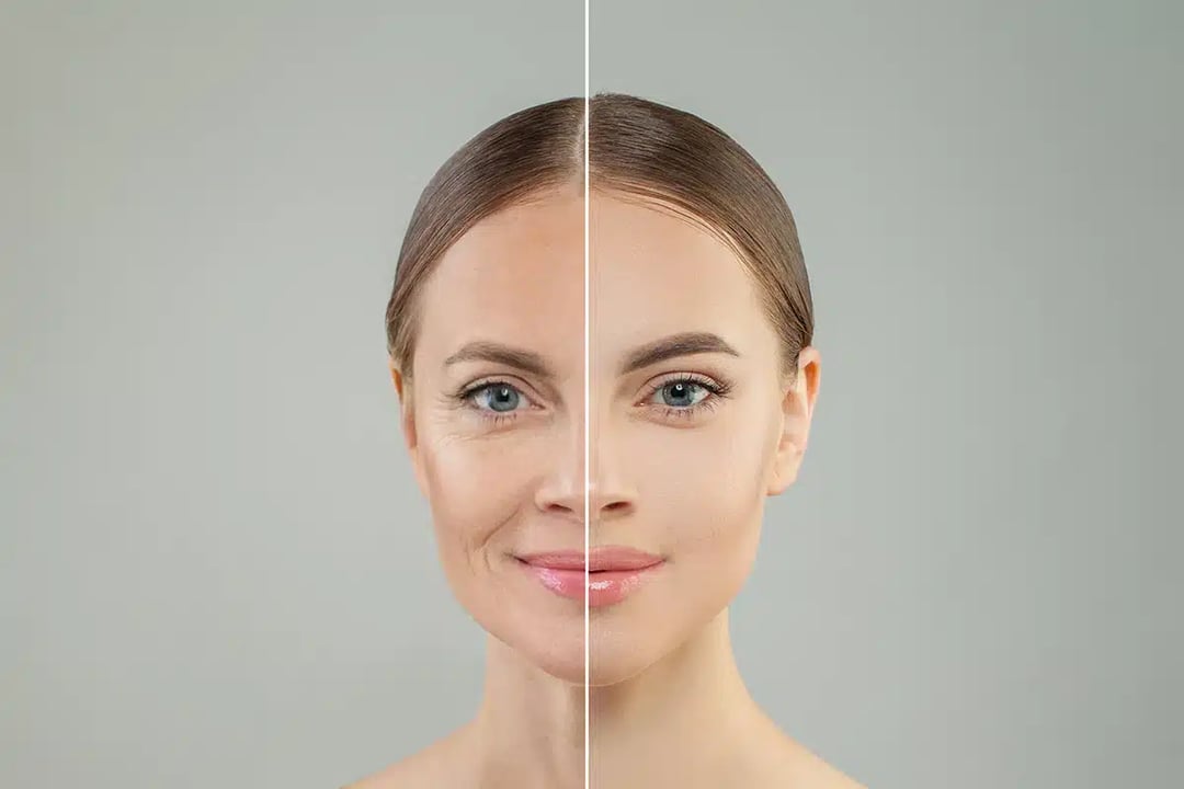 Eliminate Sagging Skin with a Brow Lift