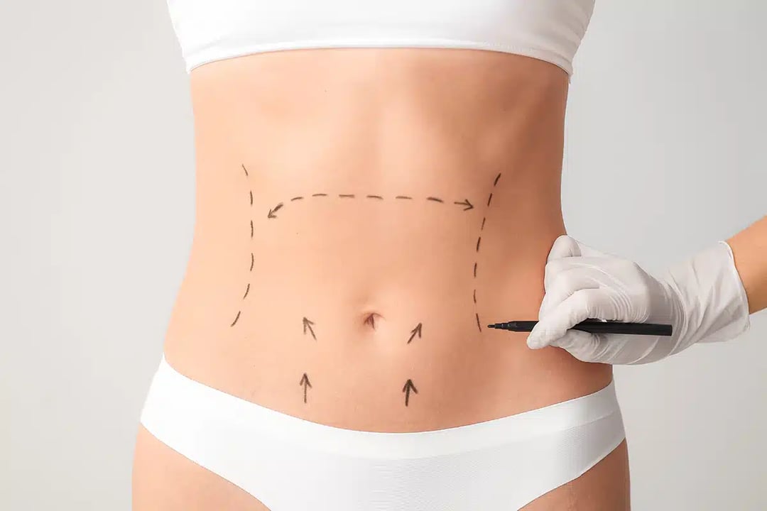 Abdominoplasty Plano