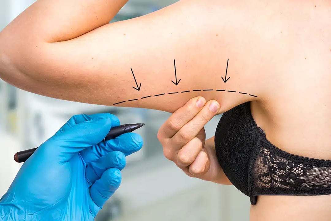 Get More Defined Arms with an Arm Lift Surgery