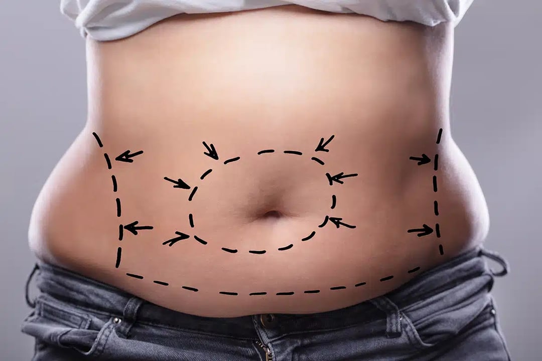 Tummy Tuck Plano