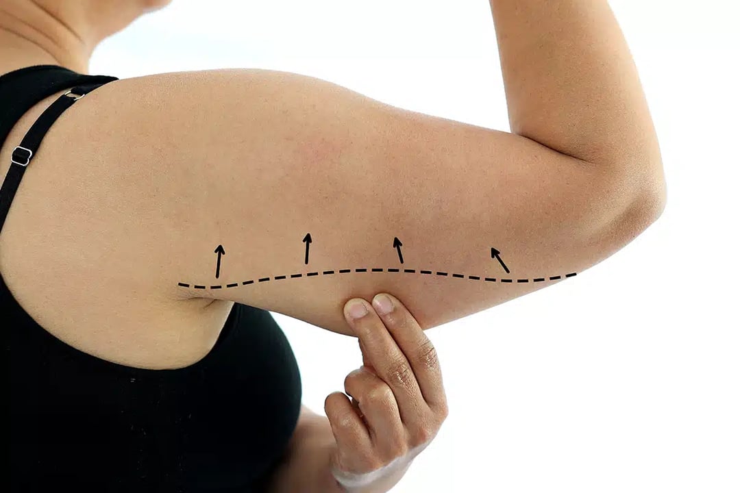 Get Beautiful-Looking Arms with an Arm Lift