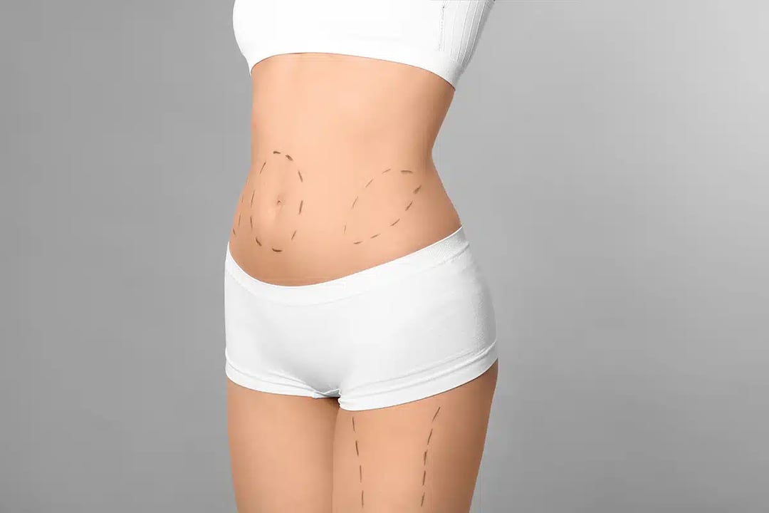 Get a Head Start on Your New Year’s Resolution with a Liposuction