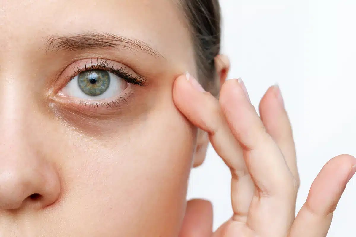 A young Caucasian woman demonstrating dark circles under her eyes with hand