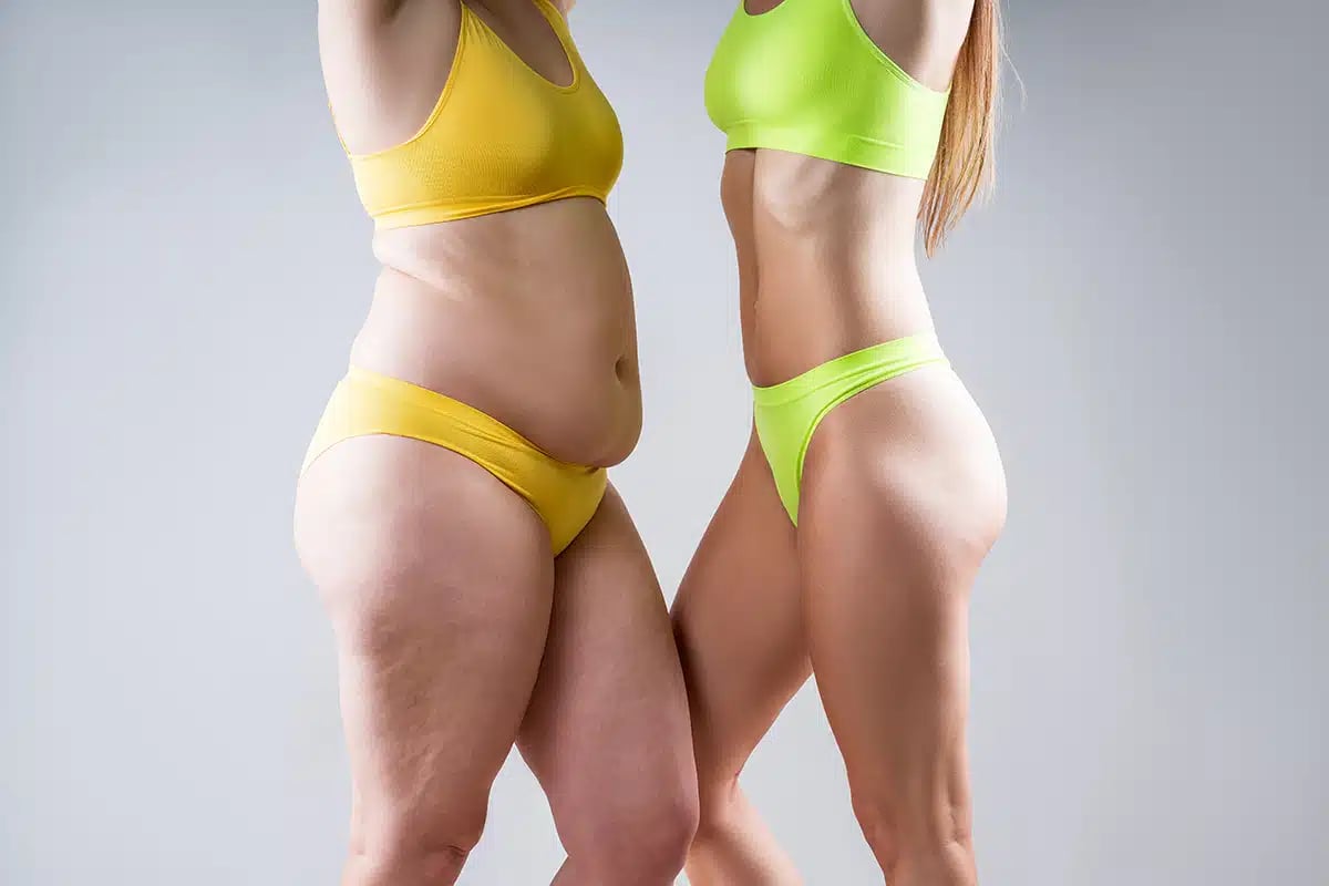 Before after weight loss, tummy tuck fat and thin women with flabby and muscular bellies