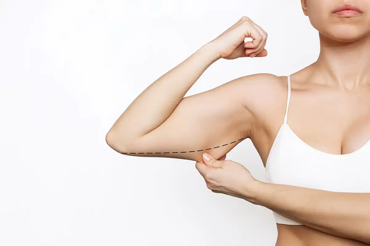 Cropped shot of a young Caucasian slim woman grabbing skin on her upper arm with marks for liposuction or plastic surgery Cropped shot of a young Caucasian slim woman grabbing skin on her upper arm with marks for liposuction or plastic surgery