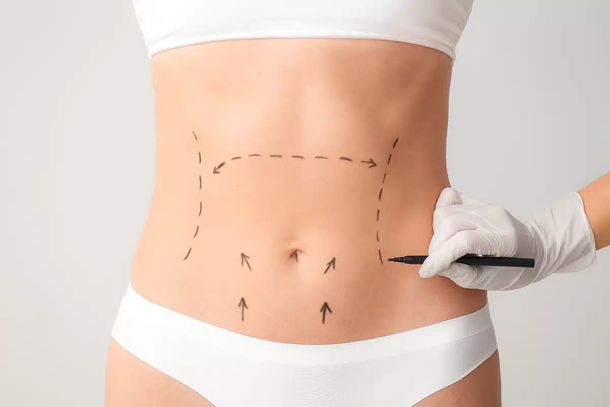 Tummy Tuck Surgical Markings Plastic surgeon marking abdomen before tummy tuck procedure
