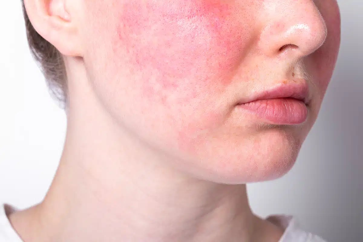 Rosacea coupe rose redness skin red spots on cheeks young woman with sensitive skin