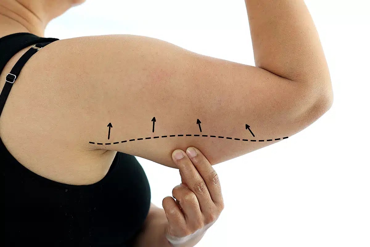woman with excess fat on her upper arm with marks for liposuction