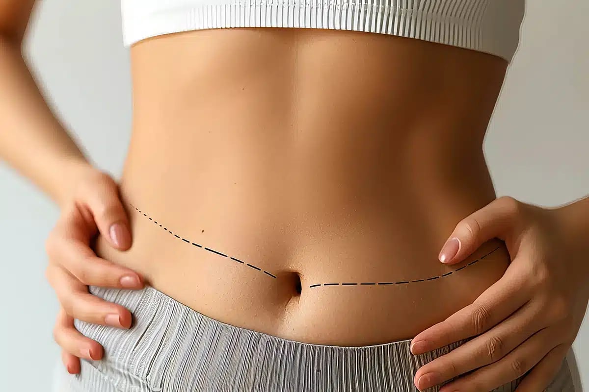 Abdomen with surgical markings before abdominoplasty procedure