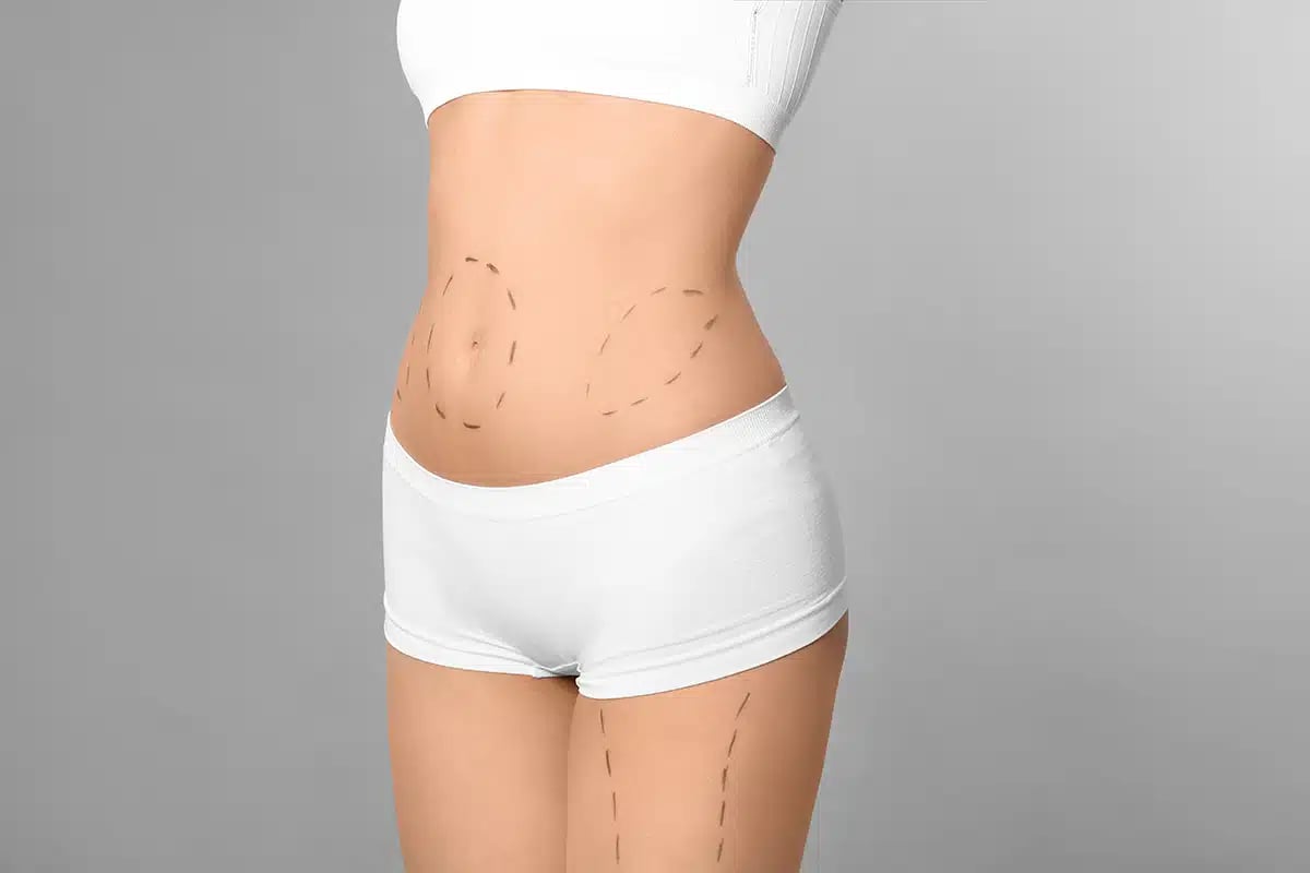Young woman with marks on body for cosmetic surgery operation