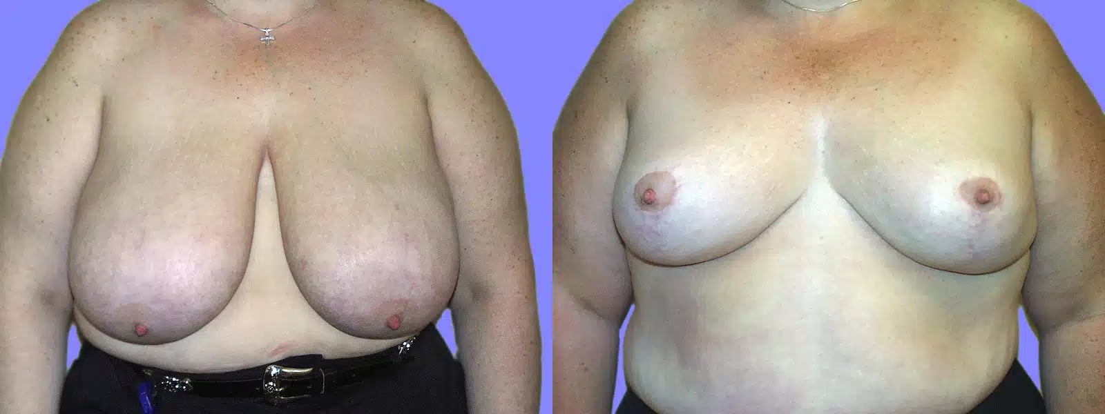 Breast Reduction before and after photo by American Institute For Plastic Surgery in Plano, TX Breast Reduction before and after photo by American Institute For Plastic Surgery in Plano, TX
