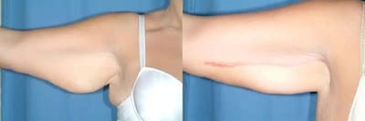 Arm Lift before and after photo by American Institute For Plastic Surgery in Plano, TX