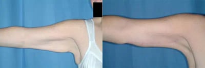 Arm Lift before and after photo by American Institute For Plastic Surgery in Plano, TX