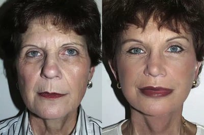 Face and Neck Lift before and after photo by American Institute For Plastic Surgery in Plano, TX