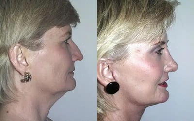 Face and Neck Lift before and after photo by American Institute For Plastic Surgery in Plano, TX