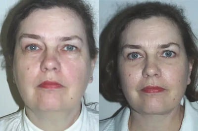 Face and Neck Lift before and after photo by American Institute For Plastic Surgery in Plano, TX