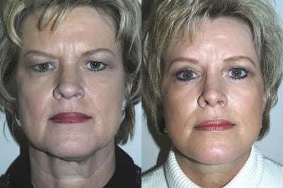 Face and Neck Lift before and after photo by American Institute For Plastic Surgery in Plano, TX
