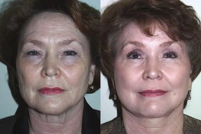 Face and Neck Lift before and after photo by American Institute For Plastic Surgery in Plano, TX
