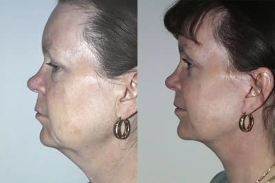 Face and Neck Lift before and after photo by American Institute For Plastic Surgery in Plano, TX