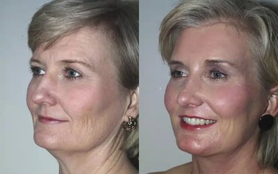 Face and Neck Lift before and after photo by American Institute For Plastic Surgery in Plano, TX