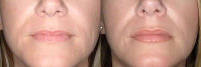 Lip Augmentation before and after photo by American Institute For Plastic Surgery in Plano, TX