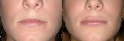 Lip Augmentation before and after photo by American Institute For Plastic Surgery in Plano, TX