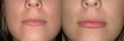 Lip Augmentation before and after photo by American Institute For Plastic Surgery in Plano, TX