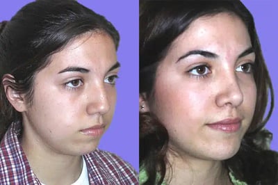 Rhinoplasty before and after photo by American Institute For Plastic Surgery in Plano, TX
