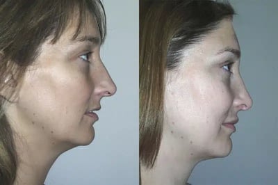 Rhinoplasty before and after photo by American Institute For Plastic Surgery in Plano, TX