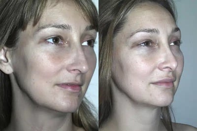 Rhinoplasty Before and After Photo in Plano, TX Rhinoplasty before and after results