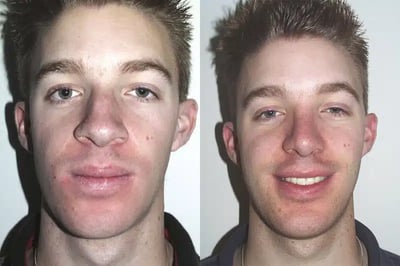 Rhinoplasty before and after photo by American Institute For Plastic Surgery in Plano, TX