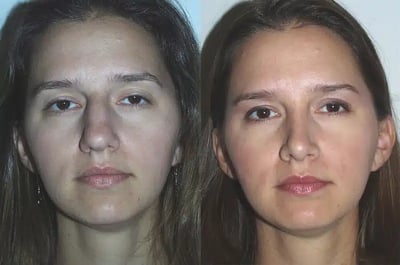 Rhinoplasty Before and After Results Nose reshaping surgery before and after photo