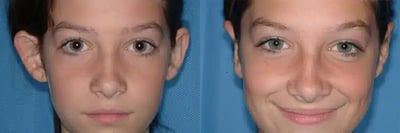 Otoplasty before and after photo by American Institute For Plastic Surgery in Plano, TX