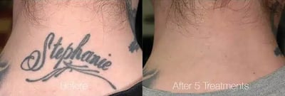 Tattoo Removal with PiQo4 before and after photo by American Institute For Plastic Surgery in Plano, TX