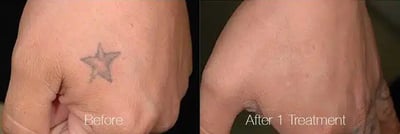Tattoo Removal with PiQo4 before and after photo by American Institute For Plastic Surgery in Plano, TX