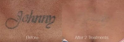 Tattoo Removal with PiQo4 before and after photo by American Institute For Plastic Surgery in Plano, TX
