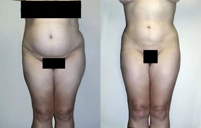 Liposuction before and after photo by American Institute For Plastic Surgery in Plano, TX