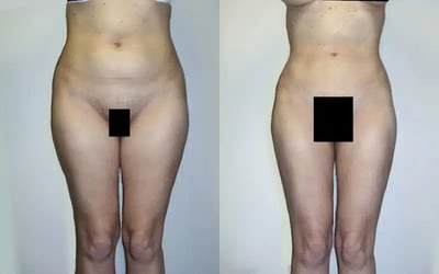 Thigh liposuction before and after results, front view