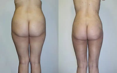 Liposuction Before and After Results Before and after liposuction transformation photo