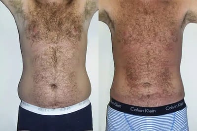 Liposuction before and after photo by American Institute For Plastic Surgery in Plano, TX