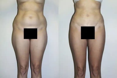 Liposuction before and after photo by American Institute For Plastic Surgery in Plano, TX
