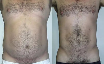 Liposuction before and after photo by American Institute For Plastic Surgery in Plano, TX
