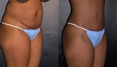 Liposuction before and after photo by American Institute For Plastic Surgery in Plano, TX