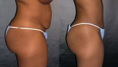 Buttock Contouring Before and After Photo Buttock contouring before and after results, side view