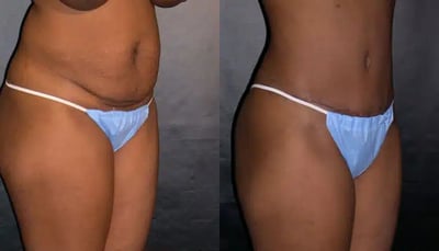 Tummy tuck before and after results showing abdominal contour improvement