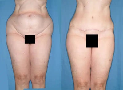 Tummy tuck results with improved waistline and excess skin removal